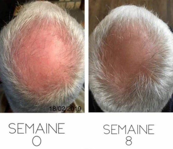 La perte de cheveux à Toulouse