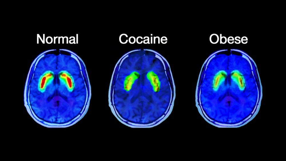 Relation dopamine et prise de poids à Toulouse